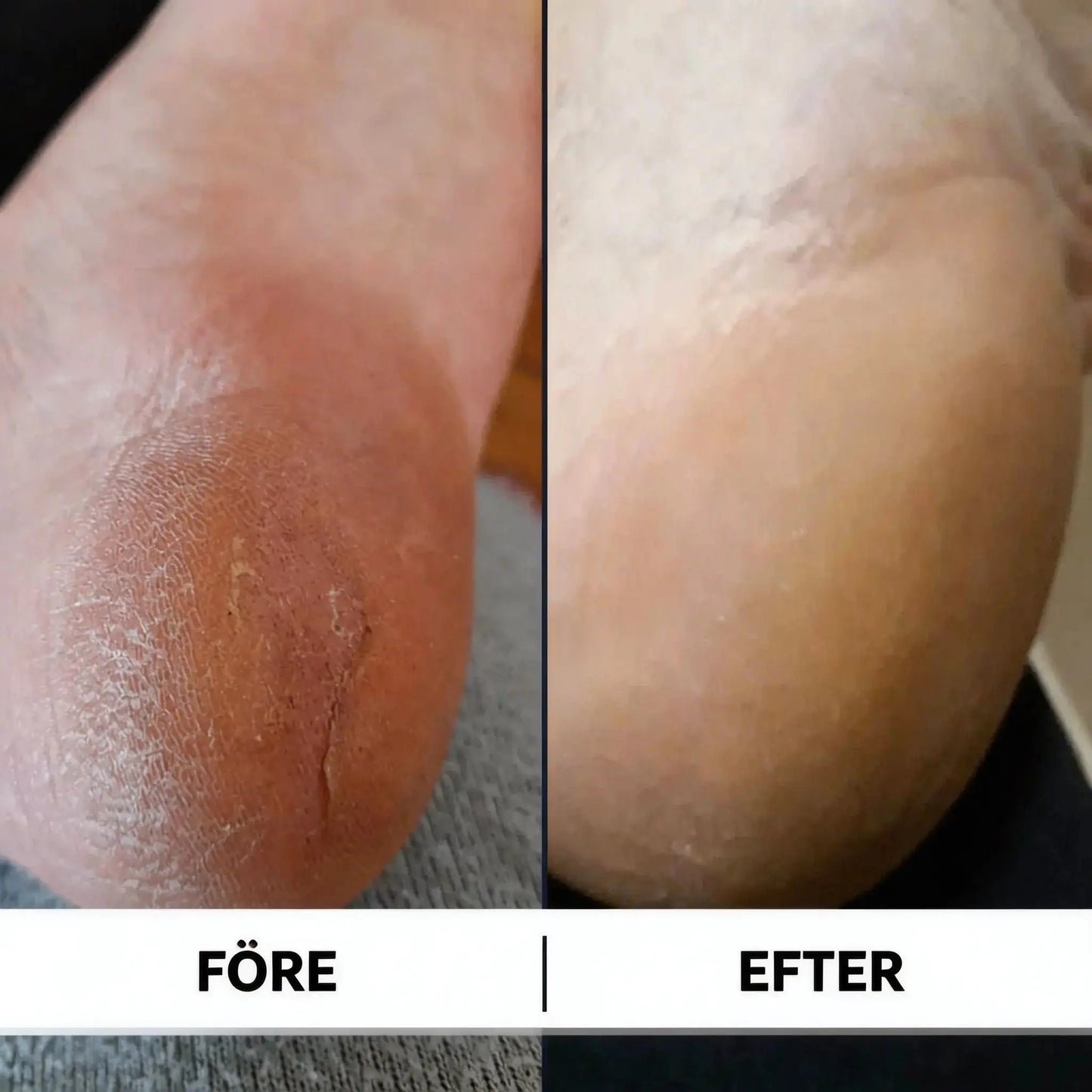 Mjukafötter™ reparerande fotstick Mjukafötter