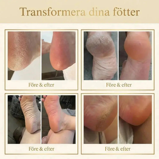 TA BORT SPRUCKNA HÄLAR - Mjukafötter