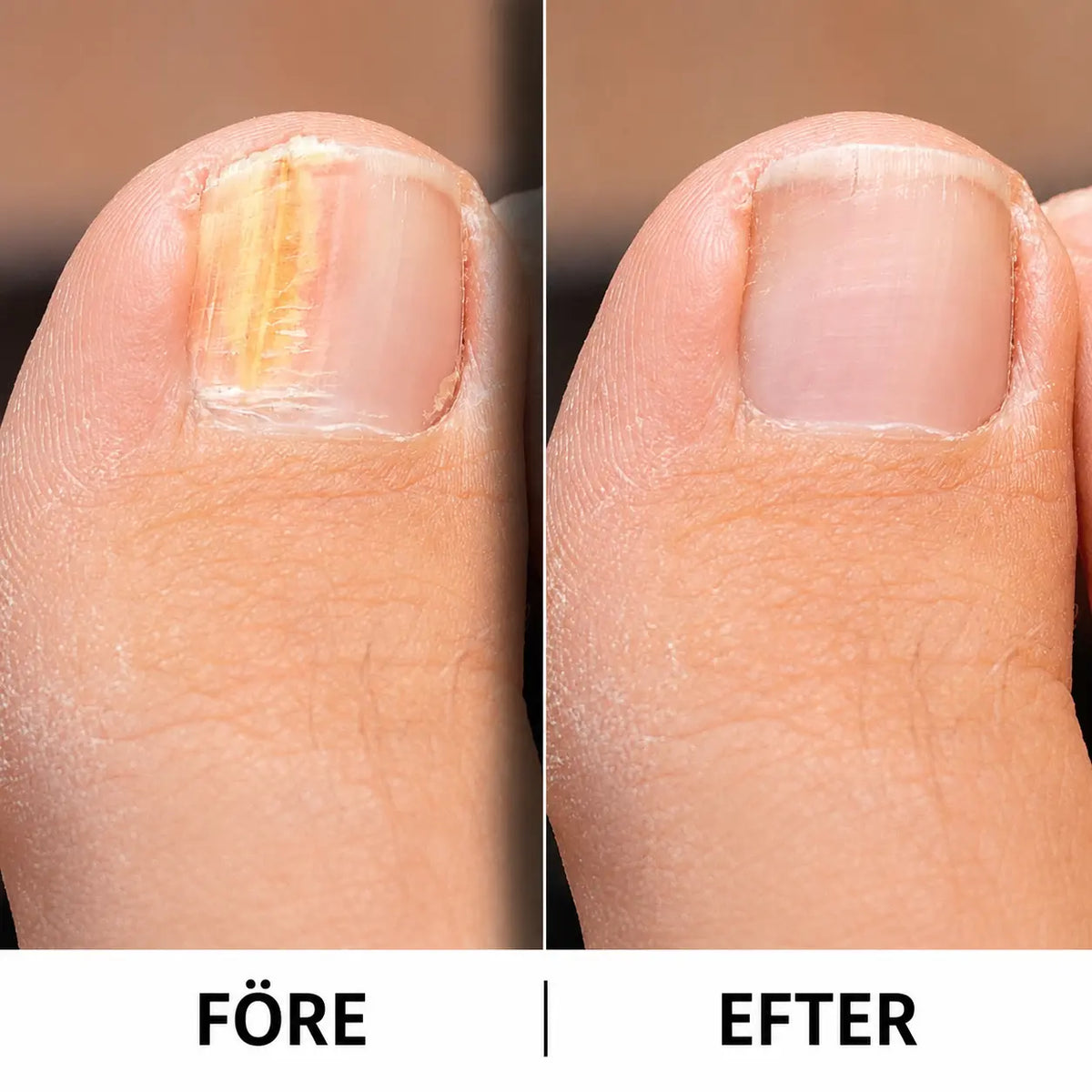 Nagelsvamp Behandling – Nail Fungus Solution || Mjukafötter Mjukafötter