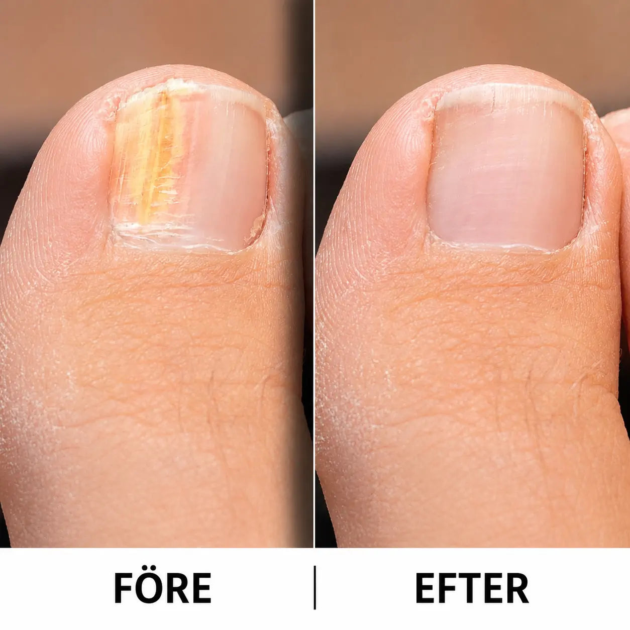 Nagelsvamp Behandling – Nail Fungus Solution || Mjukafötter Mjukafötter